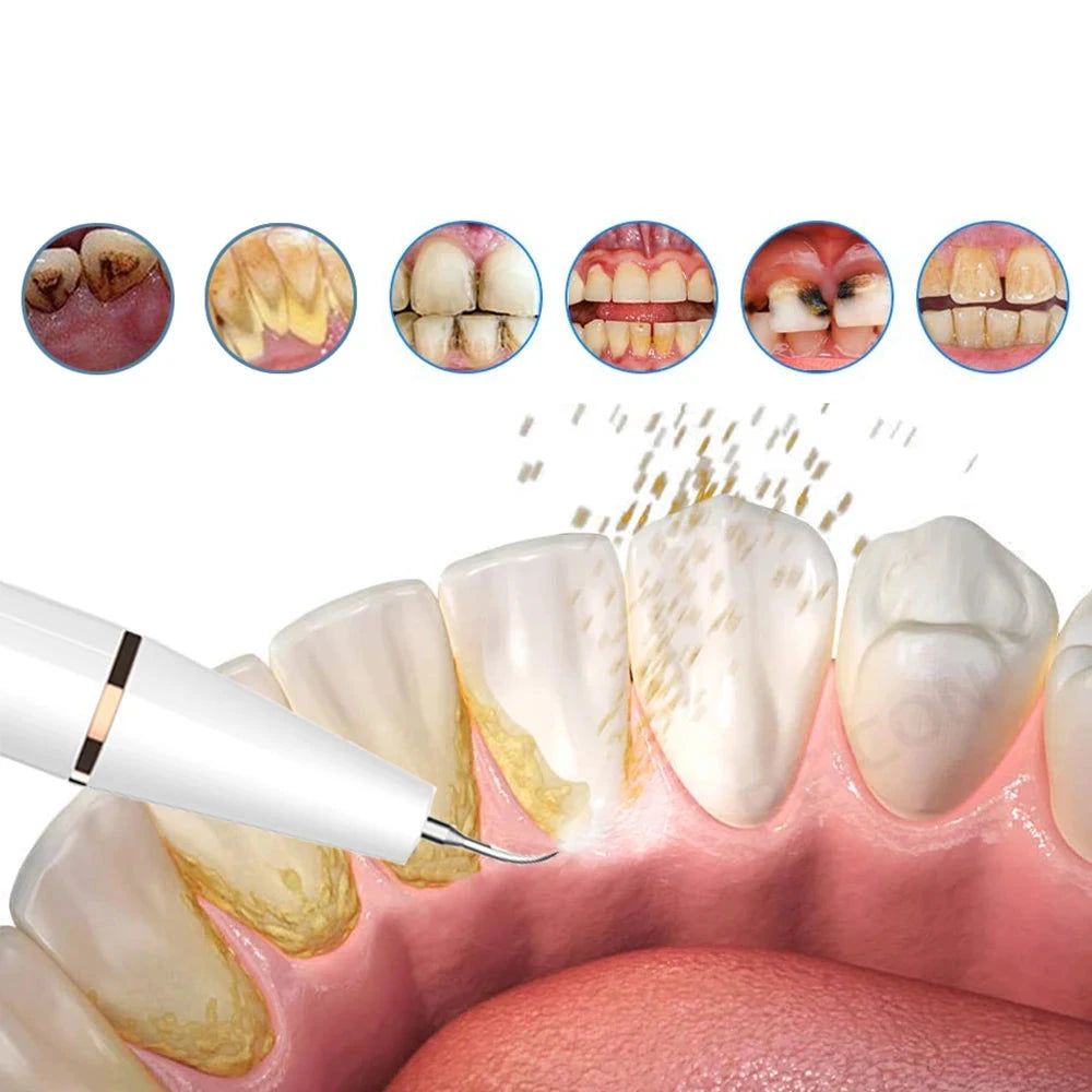 FreshScale - Ultraschall-Plaque- und Zahnsteinentferner 1