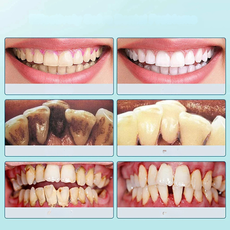 FreshScale - Ultraschall-Plaque- und Zahnsteinentferner 2