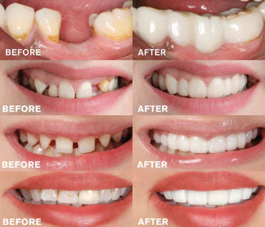 HelleBiss EasyClick – Easy to apply dental prosthesis